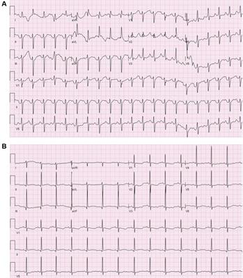 Case report: Use of therapeutic drug monitoring and pharmacogenetic testing as opportunities to individualize care in a case of flecainide toxicity after fetal supraventricular tachycardia